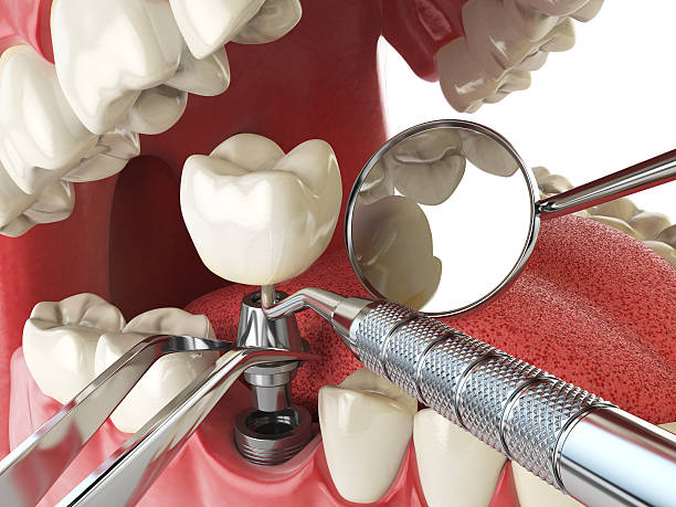 Best Urgent Care for Lost Fillings or Crowns in Brooksville, MS